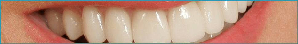 Особенности имплантации передних зубов